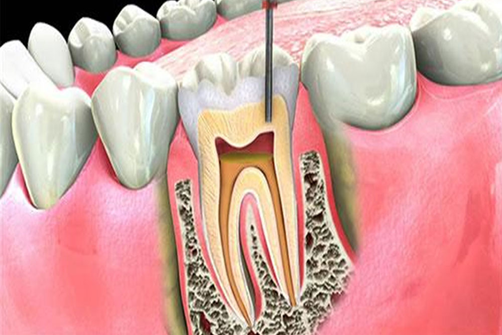 Endodonzia